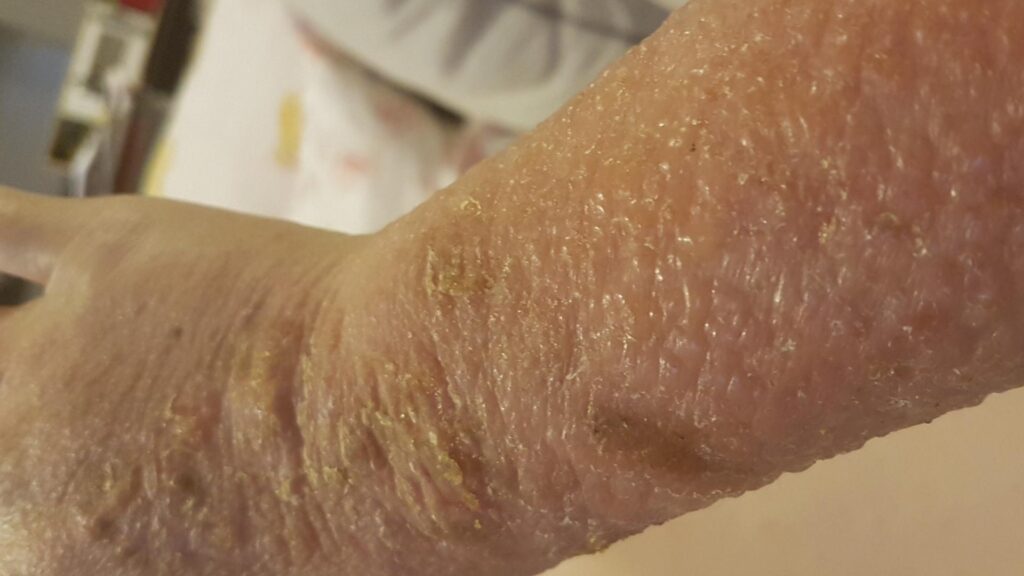 11 June 2017 - Skin surface was very damaged